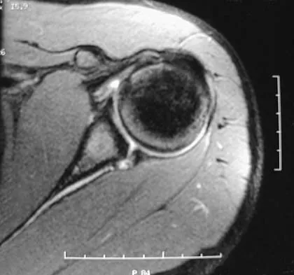 Upper Extremity Board Review 2005: High-Yield MCQs (Set 2) - Figure 25