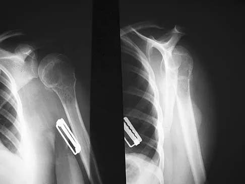 Upper Extremity Board Review 2005: High-Yield MCQs (Set 2) - Figure 6
