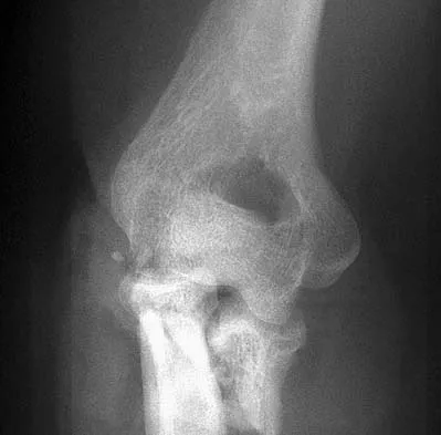 Upper Extremity Board Review 2005: High-Yield MCQs (Set 4) - Figure 15