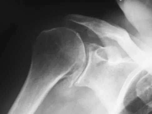 Upper Extremity 2008 MCQs - Part 1