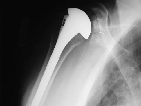 Upper Extremity 2008 Practice Questions: Set 1 (Solved) - Figure 17