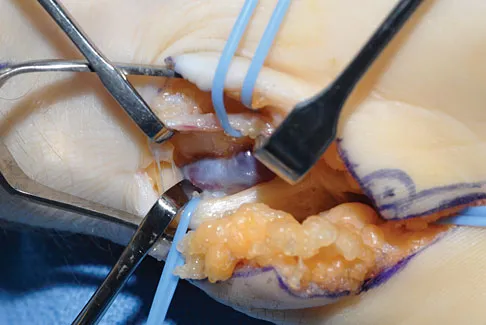 Upper Extremity 2008 Practice Questions: Set 1 (Solved) - Figure 21