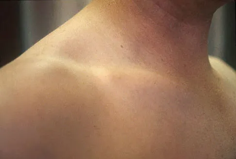 Upper Extremity Board Review 2008: High-Yield MCQs (Set 2) - Figure 15