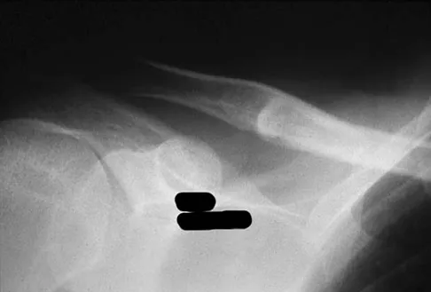 Upper Extremity Board Review 2008: High-Yield MCQs (Set 2) - Figure 16