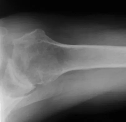 Upper Extremity Board Review 2008: High-Yield MCQs (Set 2) - Figure 32