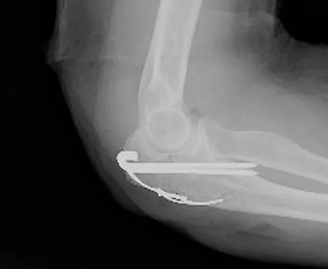 Upper Extremity 2008 Practice Questions: Set 3 (Solved) - Figure 6