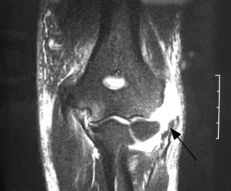 Upper Extremity Orthopedic MCQs (Set 4): Shoulder, Elbow & Wrist Trauma | ABOS & OITE Board Review