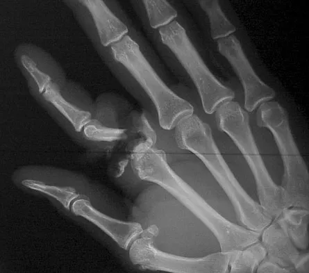 Upper Extremity Board Review 2008: High-Yield MCQs (Set 4) - Figure 15