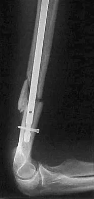 Upper Extremity 2026 MCQs: Board Review Questions & Answers (Part 1) - Figure 45