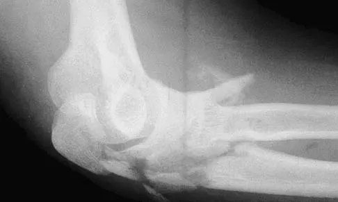 Upper Extremity 2026 MCQs: Board Review Questions & Answers (Part 2) - Figure 85