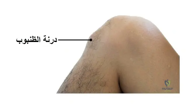 كل ما تحتاج معرفته عن التهاب صِفاق حُديبة الظنبوب (دَاءٌ أوزغود شلاتر)