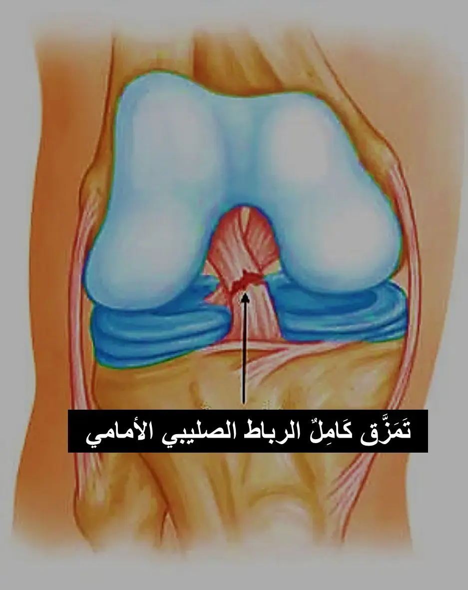 اكتشف: ثلاثية الرعب! دليل إصابات الرضوح لامتحان FRCS