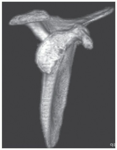 Illustration 5 for Glenoid Bone Graft for Anterior Shoulder Instability: Restore Stability