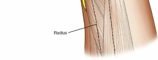 Illustration 8 for Expert Guide: Ulna and Wrist External Fixation Pin Placement