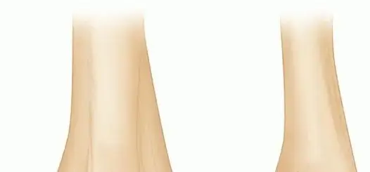 صورة توضيحية لـ كسور الكابيتلوم والبكرة العضدية: دليل شامل للمرضى نحو التعافي الكامل مع الدكتور محمد هطيف