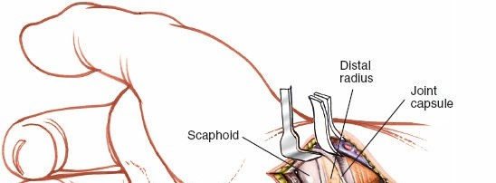 Illustration 188 for Essential Surgical Approaches: Uncover Every Aspect of the Wrist