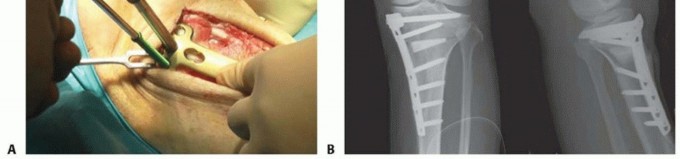 Illustration 25 for High Tibial Osteotomy: Realignment for Lasting Knee Pain Relief