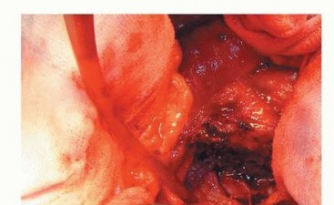 صورة طبية: نصف مفصل الورك: دليلك الشامل لدواعي الاستخدام والأنواع في صنعاء