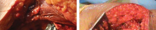 صورة طبية: مفصل الفخذ الصناعي قصير الجذع METHA: حلول مبتكرة للحفاظ على العظم في صنعاء مع الأستاذ الدكتور محمد هطيف