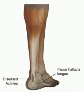 Illustration of transfer for achilles tendinosis - Dr. Mohammed Hutaif