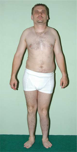 Understanding Multiple Epiphyseal Dysplasia: Orthopedic Cases