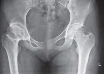 صورة طبية: مفصل الفخذ الصناعي قصير الجذع METHA: حلول مبتكرة للحفاظ على العظم في صنعاء مع الأستاذ الدكتور محمد هطيف