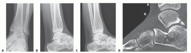 Illustration of ankle arthroscopy and hindfoot - Dr. Mohammed Hutaif