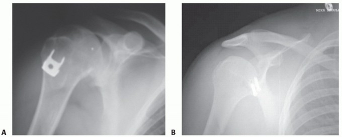 Illustration 7 for Bankart Repair & Inferior Capsular Shift: Solving Shoulder Instability