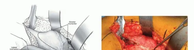 صورة توضيحية لـ سلامة خلع الورك الجراحي: الدور الحيوي للشريان الفخذي المنعطف الإنسي في الحفاظ على صحة الورك