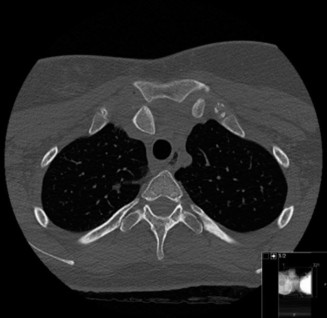 Illustration 48 for Right Shoulder Pain? Avoid This Common X-ray Mistake.