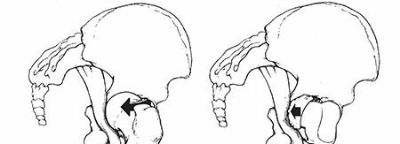 Hip Dislocations: Understanding Causes, Risks, & Outcomes