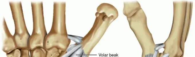 تثبيت أربطة مفصل إبهام اليد غير المستقر: دليلك الشامل لاستعادة الحركة والقوة