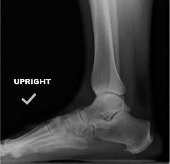 Beat Achilles Pain: How Eccentric Calf Stretching Provides Relief.