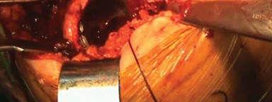 Illustration 20 for Unlock Movement: Arthroplasty for Bony Ankylosis Solutions