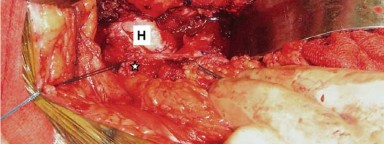 Illustration 7 for Mastering Soft Tissue Balancing for Optimal THR Outcomes