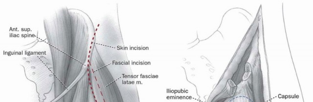 Illustration 8 for Periacetabular Osteotomy: Realigning your hip via the superior pubic ramus