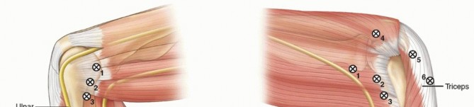 Illustration of portal dual cannula - Dr. Mohammed Hutaif