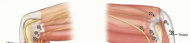 صورة توضيحية لـ تنظير مفصل المرفق: دليل شامل للمرضى نحو الشفاء التام مع الأستاذ الدكتور محمد هطيف