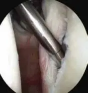 أسعار حقن العمود الفقري في اليمن 2026: كم تدفع حقاً؟