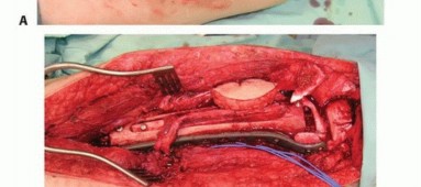 صورة طبية: ترقيع الشظية الوعائي الحر: حلول متقدمة لعيوب العظام المعقدة