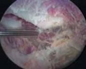 Illustration of treatment of scapulothoracic - Dr. Mohammed Hutaif