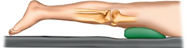 Illustration of tendon of semitendinosus - Dr. Mohammed Hutaif