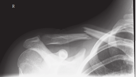 Clavicle Fracture: Essential Guide to Your Broken Clavicle