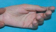 Effective Cerebral Palsy Correction for Thumb-in-Palm Deformity