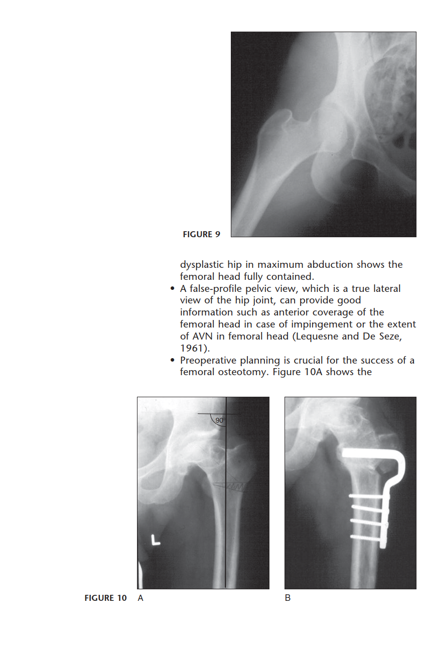 Illustration 6 for Intertrochanteric Femoral Osteotomy: Indications for Hip Preservation