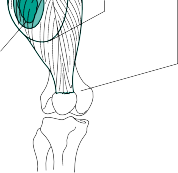 صورة طبية: دليلك الشامل للخزعات التشخيصية الدقيقة للأورام العظمية والأنسجة الرخوة