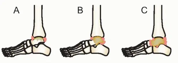 مشاكل عظم الكاحل (القدم) المعقدة: فقدان العظم، النخر اللاوعائي، والالتهابات - حلول متقدمة لعودة الحركة