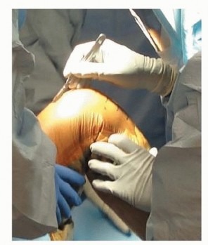 Illustration 5 for Achieve Lasting Pain Relief with Cemented Total Knee Arthroplasty