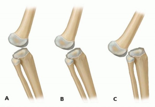 Mastering Surgical Repair for Congenital Dislocation of the Knee