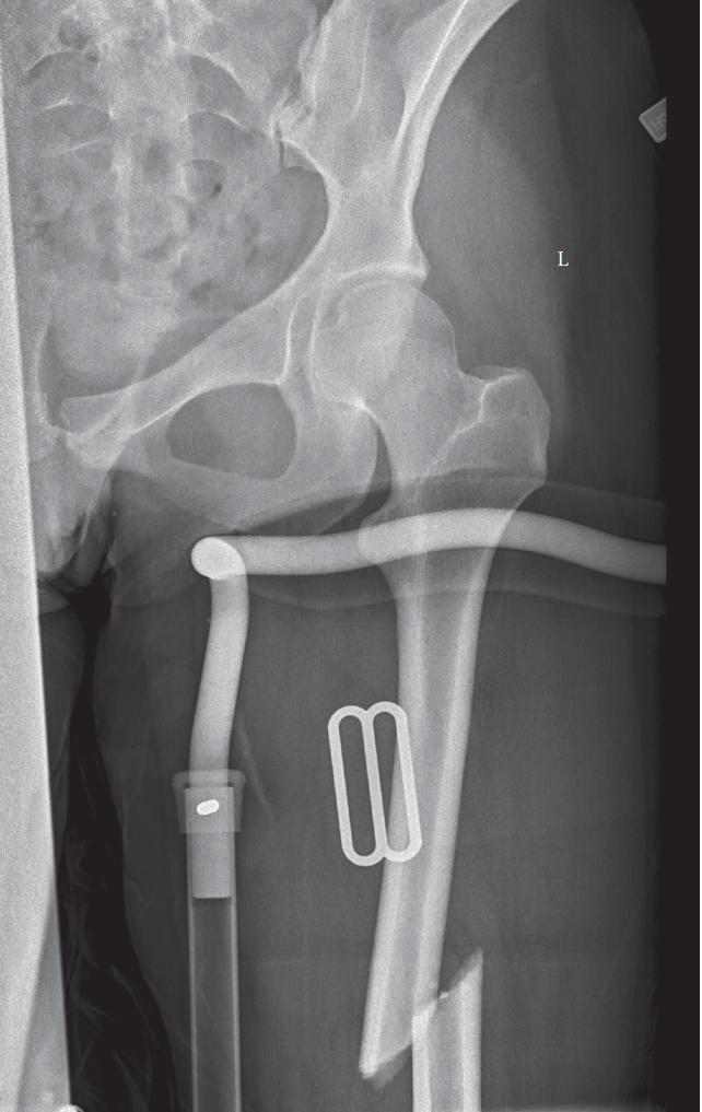 Illustration of young femoral fracture - Dr. Mohammed Hutaif